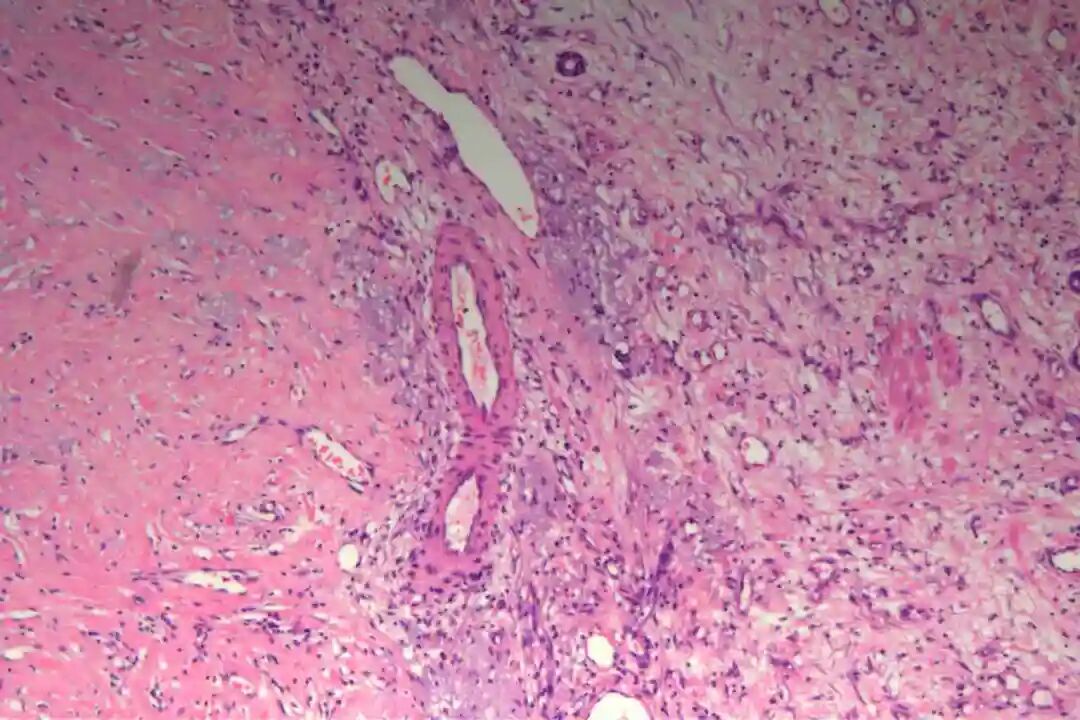 讲座|皮肤原发性平滑肌肉瘤1例介绍