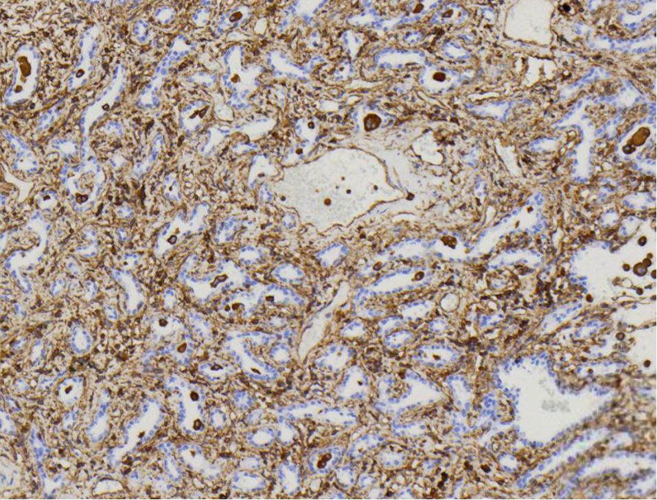 讲座|眼见不一定为实（2）--病例分享