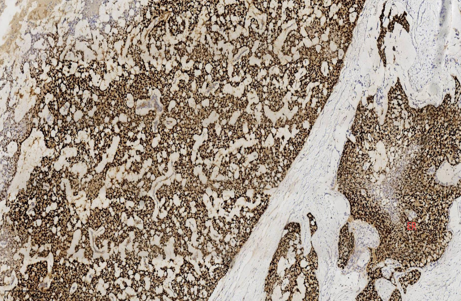 乳腺实性乳头状肿瘤诊断与鉴别诊断